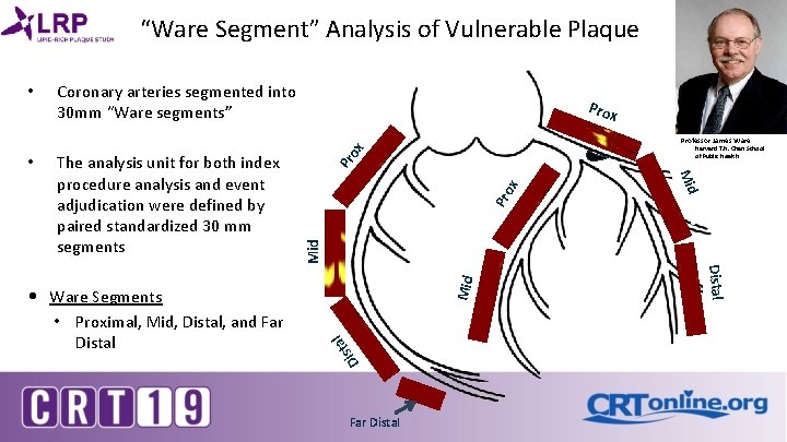 “Ware Segment” Analysis of Vulnerable Plaque • Coronary arteries segmented into 30 mm “Ware