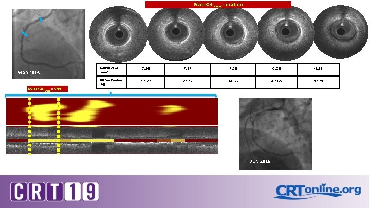 Max. LCBI 4 mm Location MAR 2016 Max. LCBI 4 mm= 583 Lumen Area