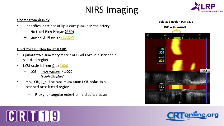 NIRS Imaging Chemogram display • Identifies locations of lipid core plaque in the artery