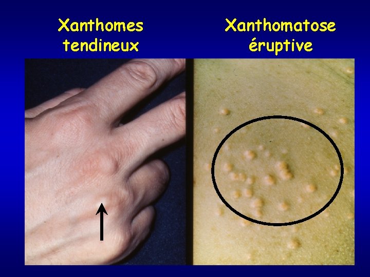 Xanthomes tendineux Xanthomatose éruptive 