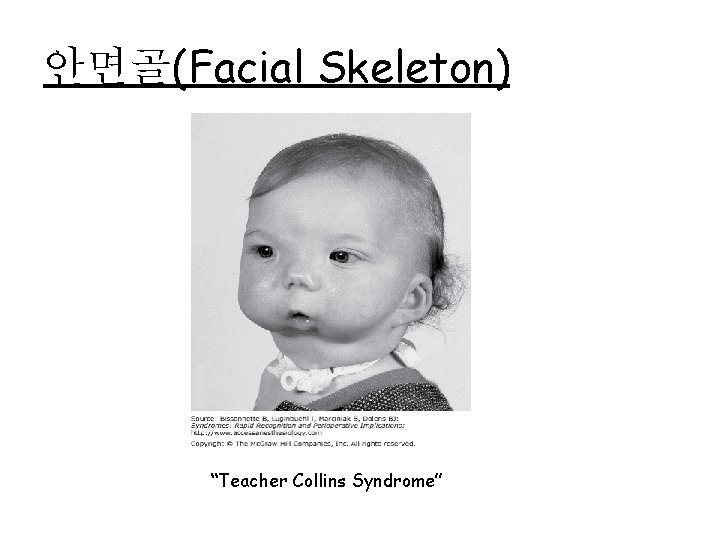 안면골(Facial Skeleton) “Teacher Collins Syndrome” 