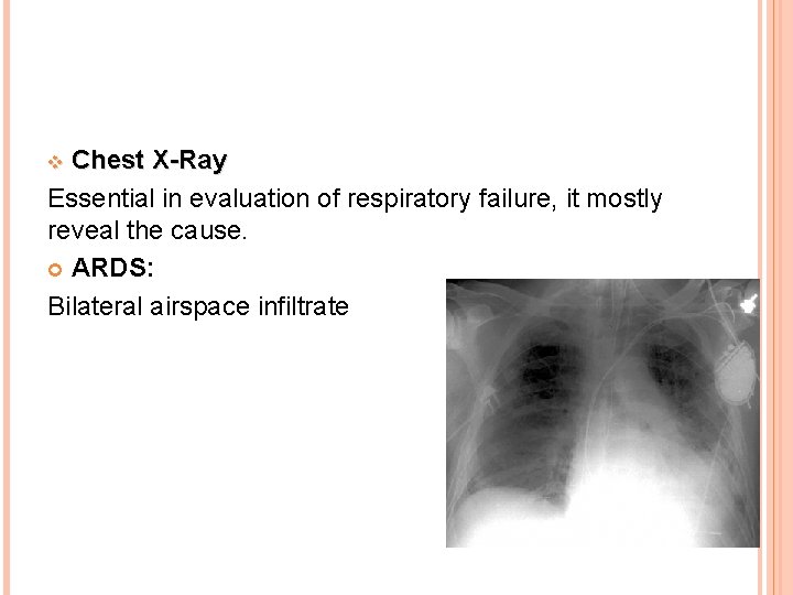 Chest X-Ray Essential in evaluation of respiratory failure, it mostly reveal the cause. ARDS: