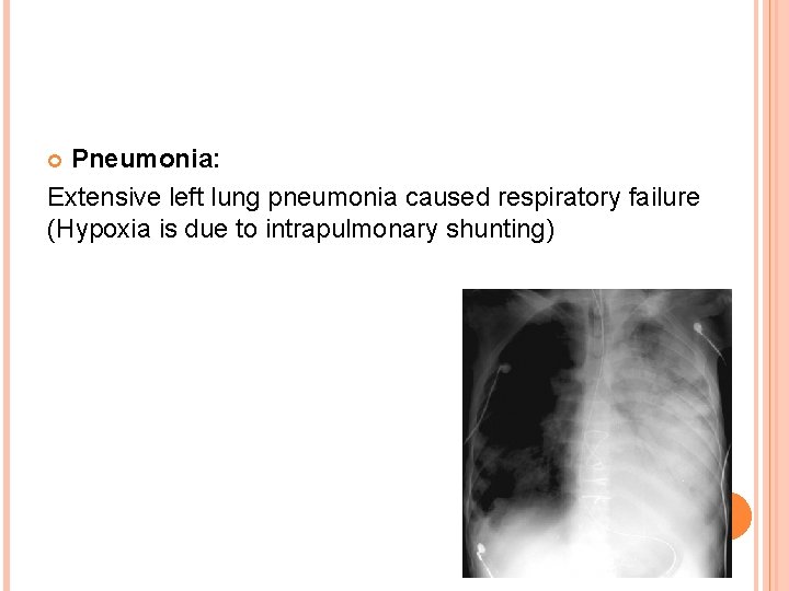 Pneumonia: Extensive left lung pneumonia caused respiratory failure (Hypoxia is due to intrapulmonary shunting)