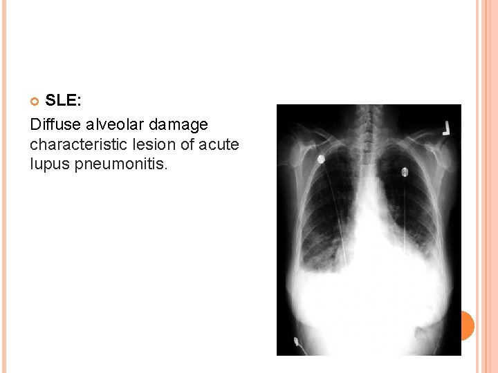 SLE: Diffuse alveolar damage characteristic lesion of acute lupus pneumonitis. 