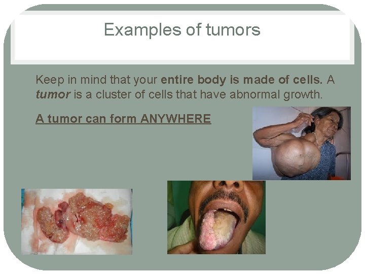 Examples of tumors • • Keep in mind that your entire body is made