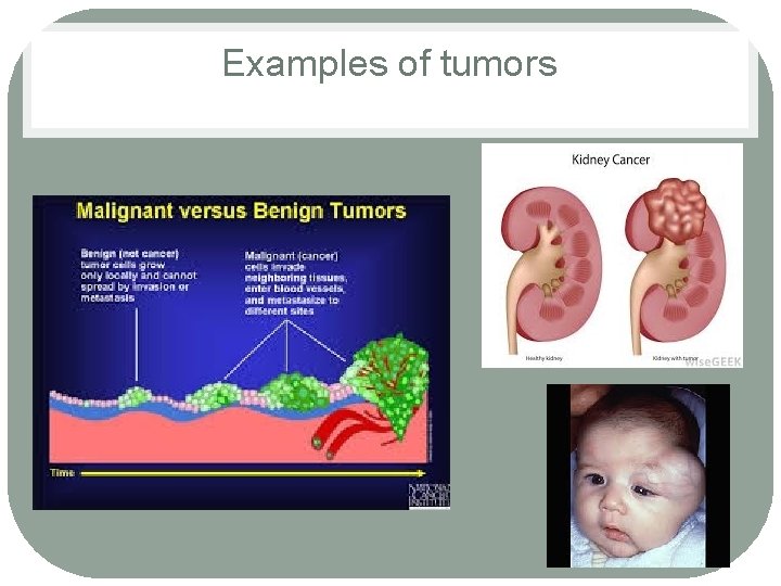 Examples of tumors 