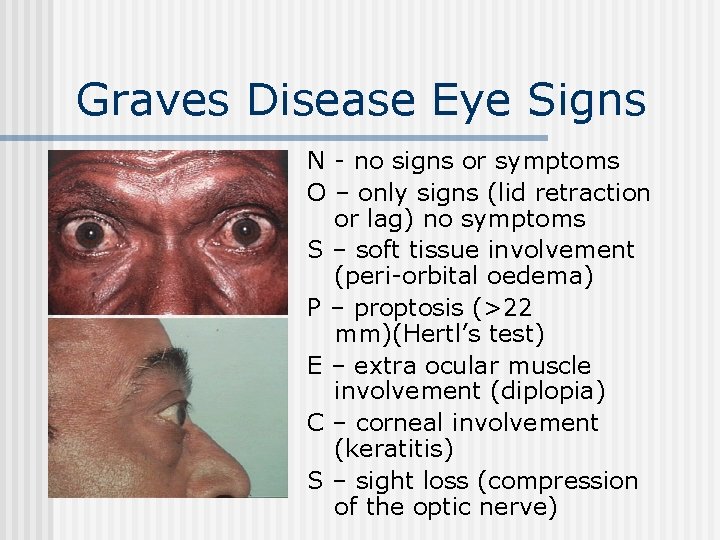 Graves Disease Eye Signs N - no signs or symptoms O – only signs