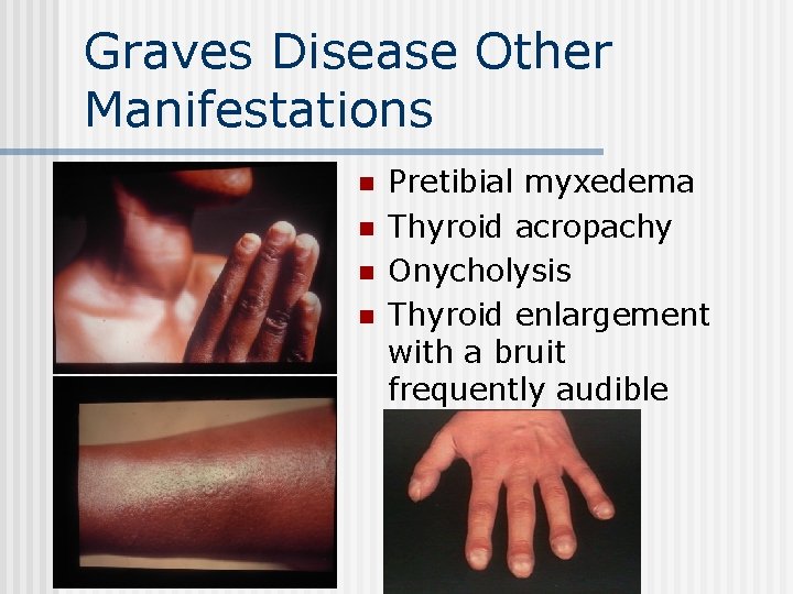 Graves Disease Other Manifestations n n Pretibial myxedema Thyroid acropachy Onycholysis Thyroid enlargement with