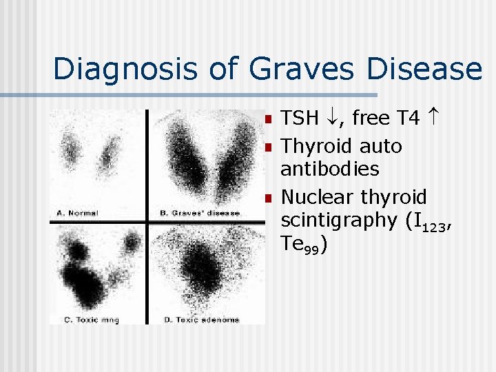 Diagnosis of Graves Disease n n n TSH , free T 4 Thyroid auto