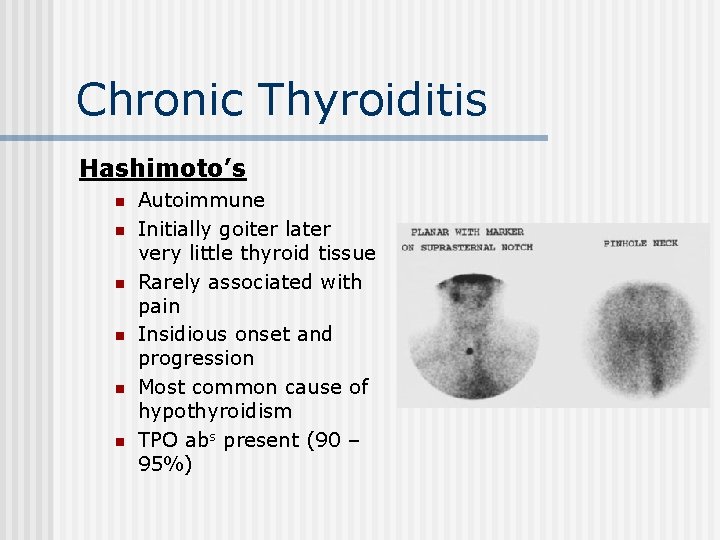 Chronic Thyroiditis Hashimoto’s n n n Autoimmune Initially goiter later very little thyroid tissue
