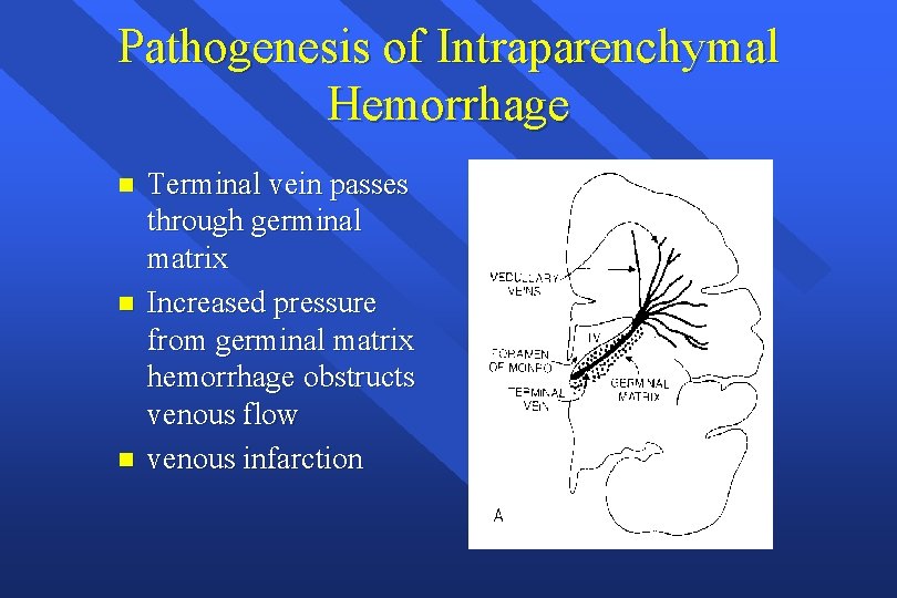 Pathogenesis of Intraparenchymal Hemorrhage n n n Terminal vein passes through germinal matrix Increased