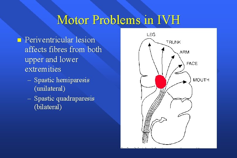 Motor Problems in IVH n Periventricular lesion affects fibres from both upper and lower