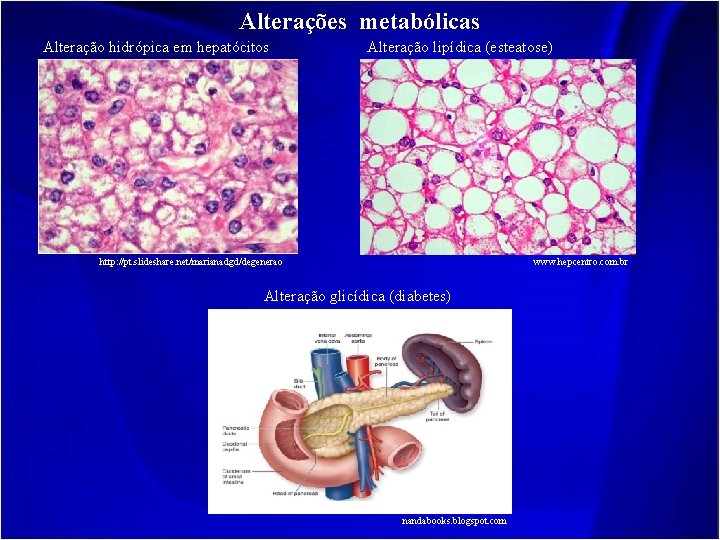 Alterações metabólicas Alteração hidrópica em hepatócitos Alteração lipídica (esteatose) http: //pt. slideshare. net/marianadgd/degenerao www.