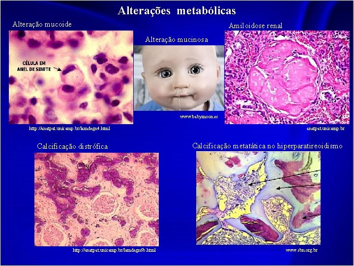 Alterações metabólicas Alteração mucoide Amiloidose renal Alteração mucinosa www. babymoon. es http: //anatpat. unicamp.