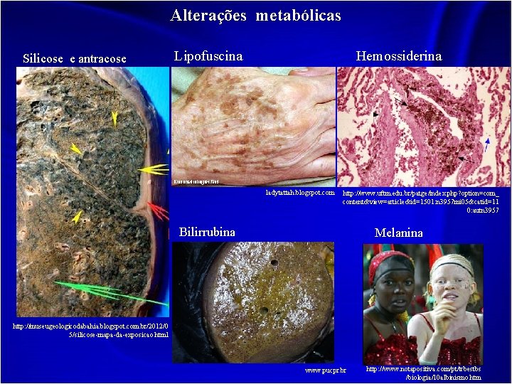 Alterações metabólicas Silicose e antracose Lipofuscina Hemossiderina ladytattah. blogspot. com http: //www. uftm. edu.