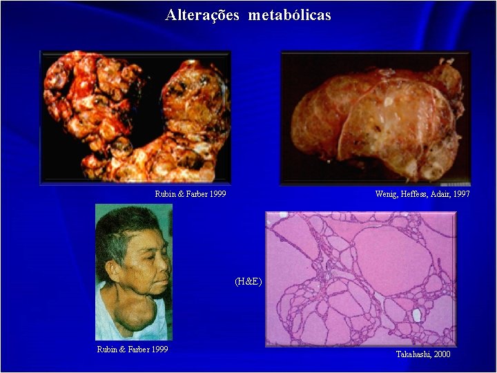 Alterações metabólicas Rubin & Farber 1999 Wenig, Heffess, Adair, 1997 (H&E) Rubin & Farber