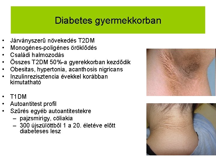 Diabetes gyermekkorban • • • Járványszerű növekedés T 2 DM Monogénes-poligénes öröklődés Családi halmozodás