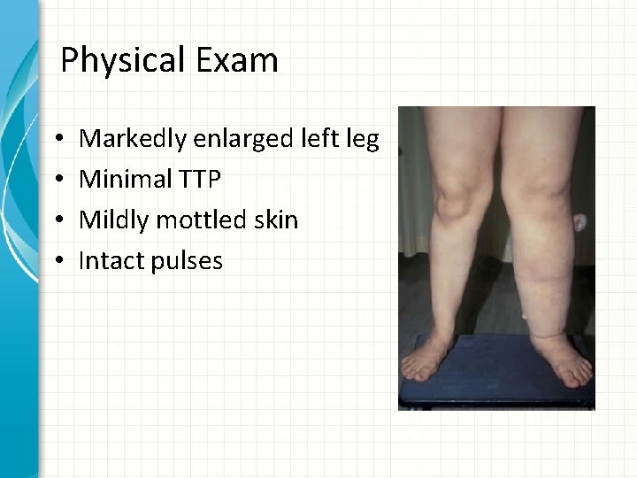 Physical Exam • • Markedly enlarged left leg Minimal TTP Mildly mottled skin Intact