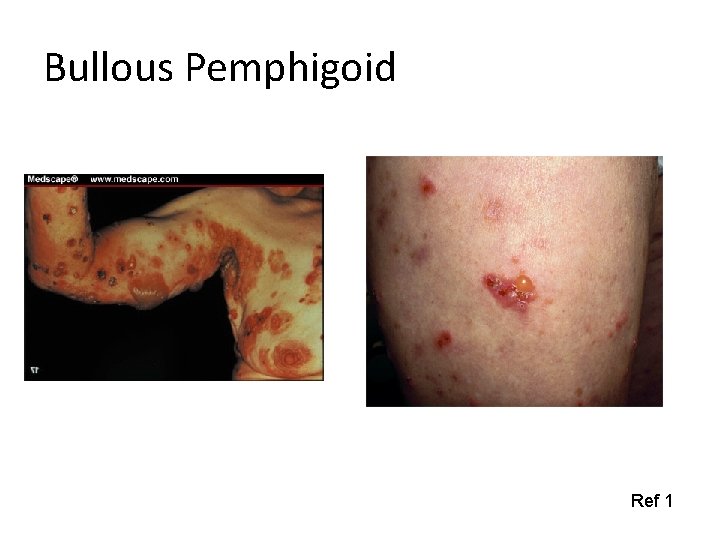 Bullous Pemphigoid Ref 1 