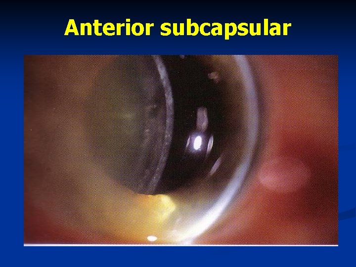 Anterior subcapsular 