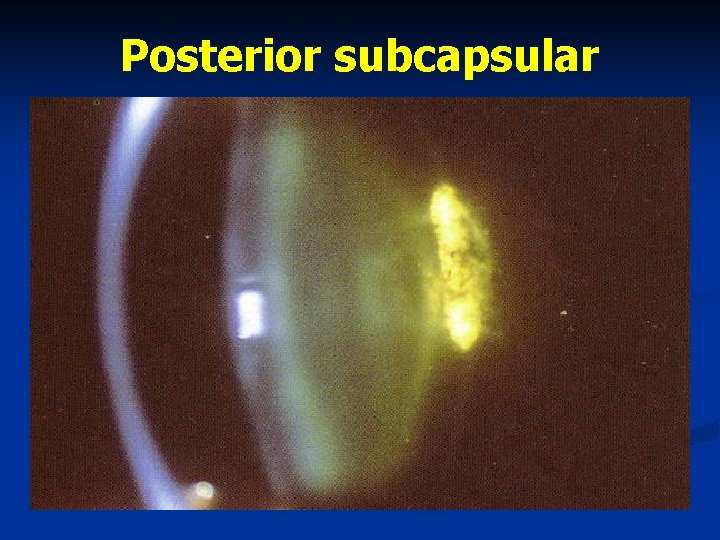 Posterior subcapsular 