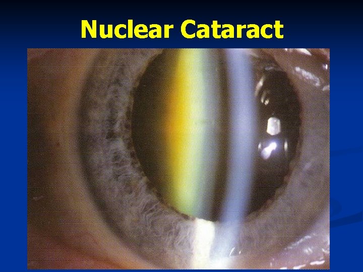 Nuclear Cataract 