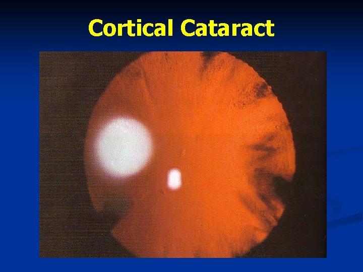 Cortical Cataract 