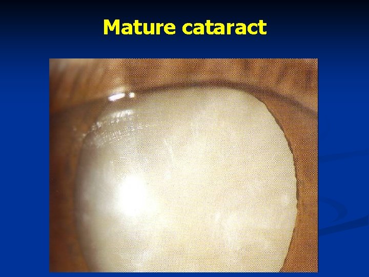 Mature cataract 