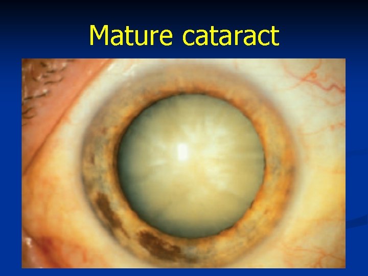 Mature cataract 