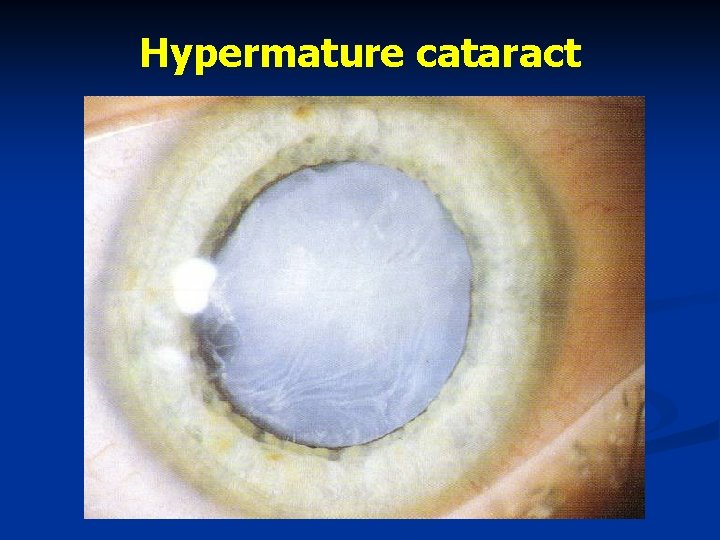 Hypermature cataract 