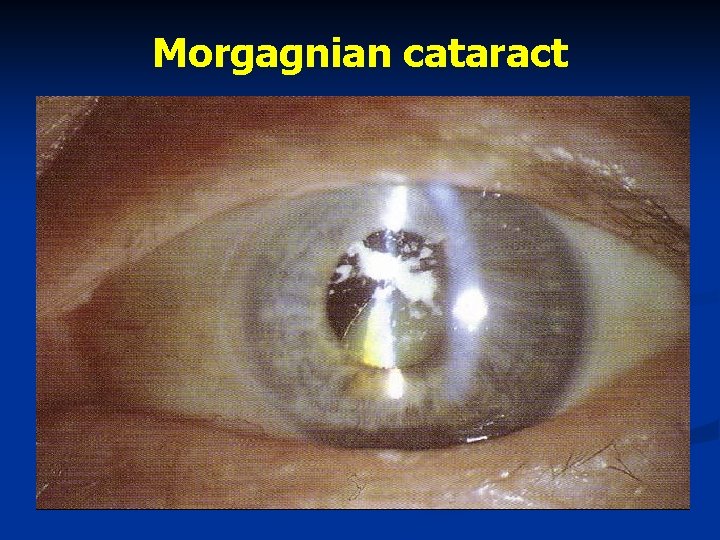 Morgagnian cataract 