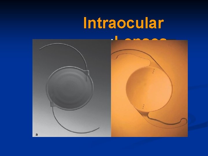 Intraocular Lenses 