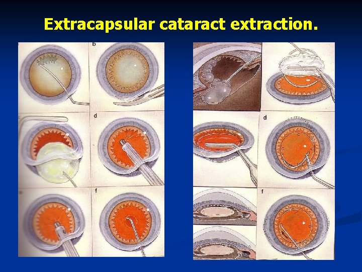 Extracapsular cataract extraction. 