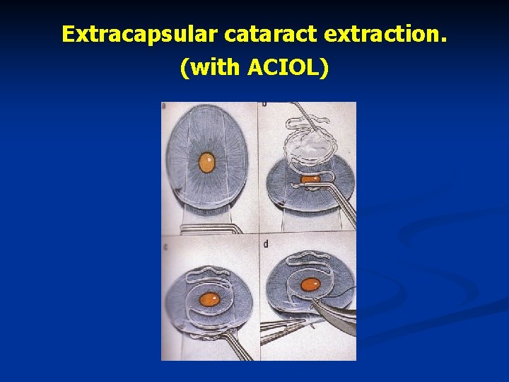 Extracapsular cataract extraction. (with ACIOL) 
