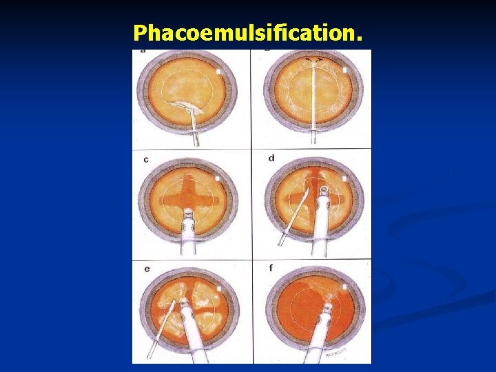 Phacoemulsification. 