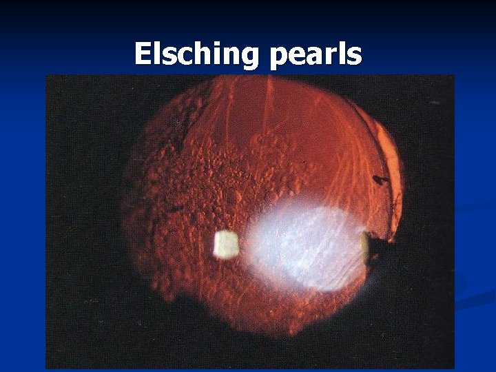Elsching pearls 