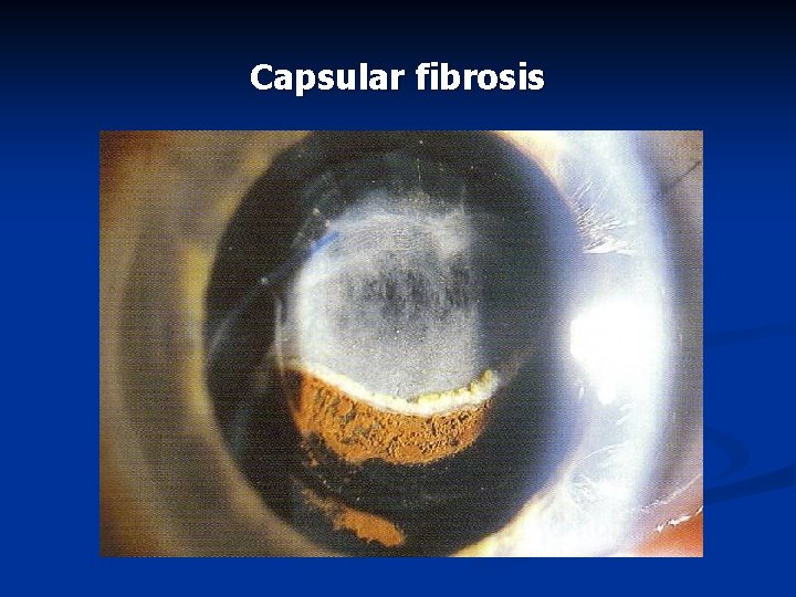 Capsular fibrosis 