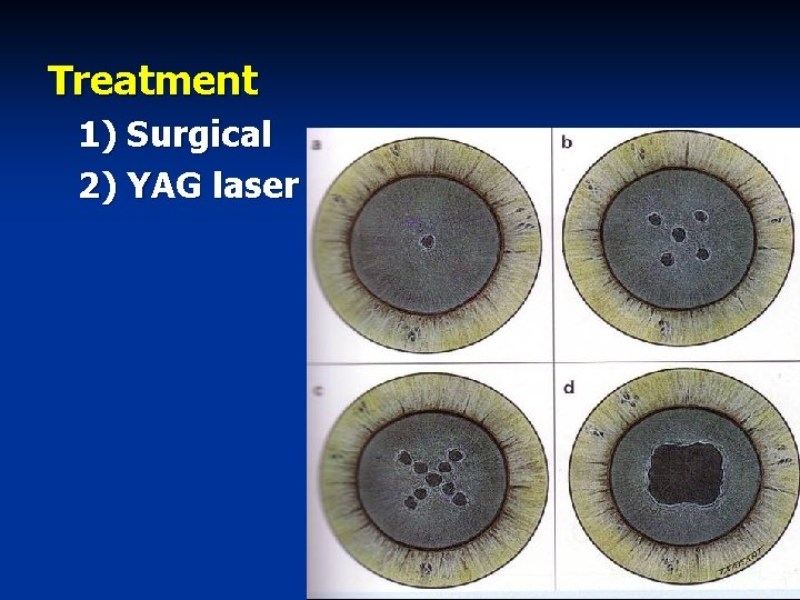 Treatment 1) Surgical 2) YAG laser 