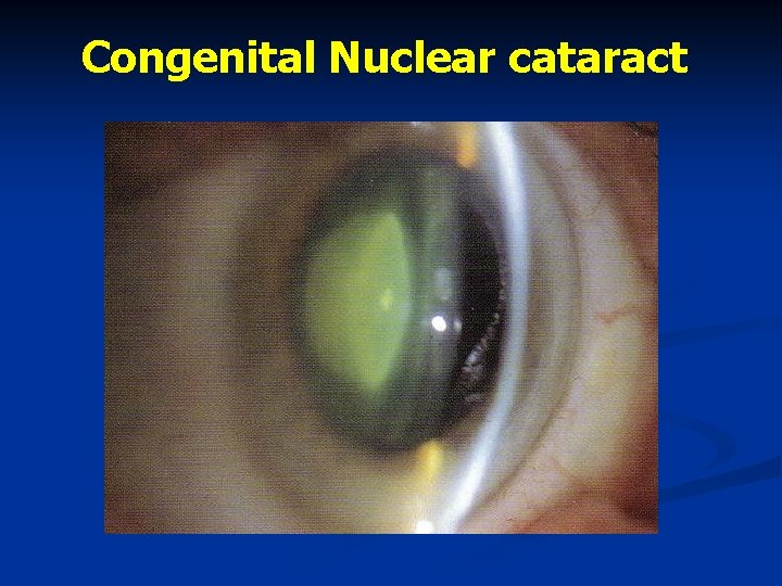 Congenital Nuclear cataract 