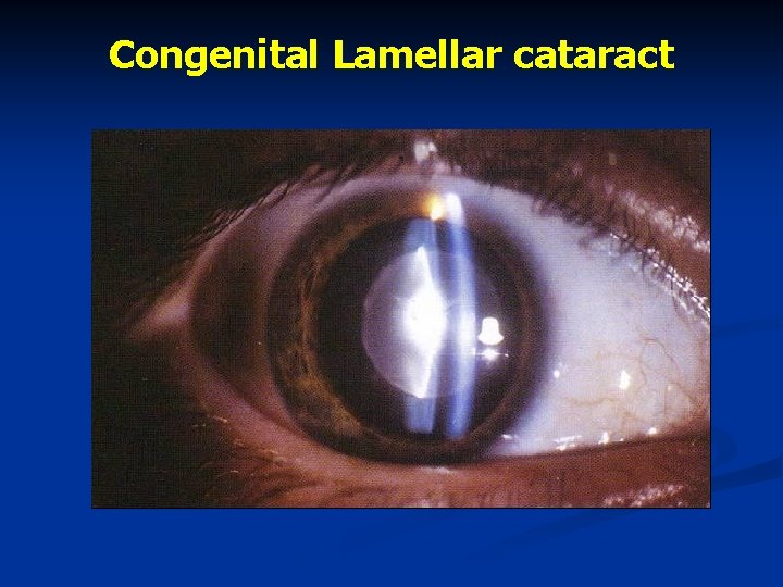Congenital Lamellar cataract 