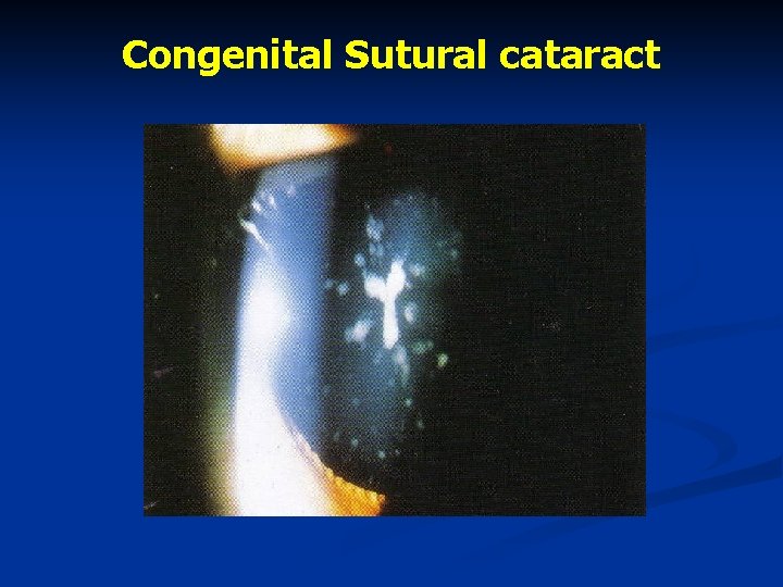 Congenital Sutural cataract 