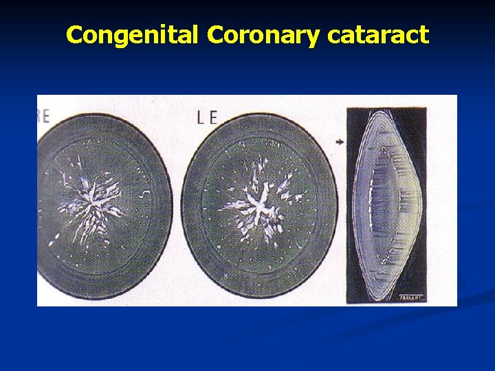 Congenital Coronary cataract 