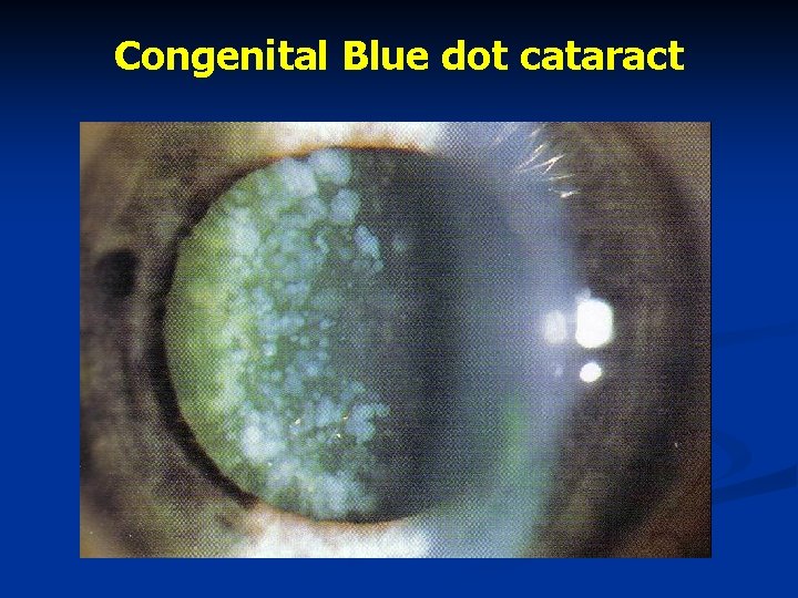 Congenital Blue dot cataract 