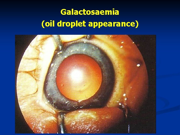 Galactosaemia (oil droplet appearance) 