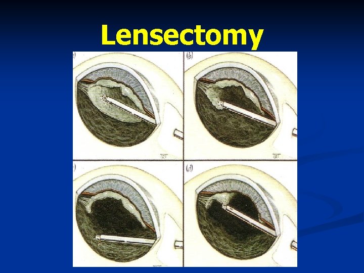Lensectomy 