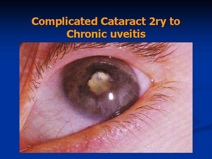 Complicated Cataract 2 ry to Chronic uveitis 