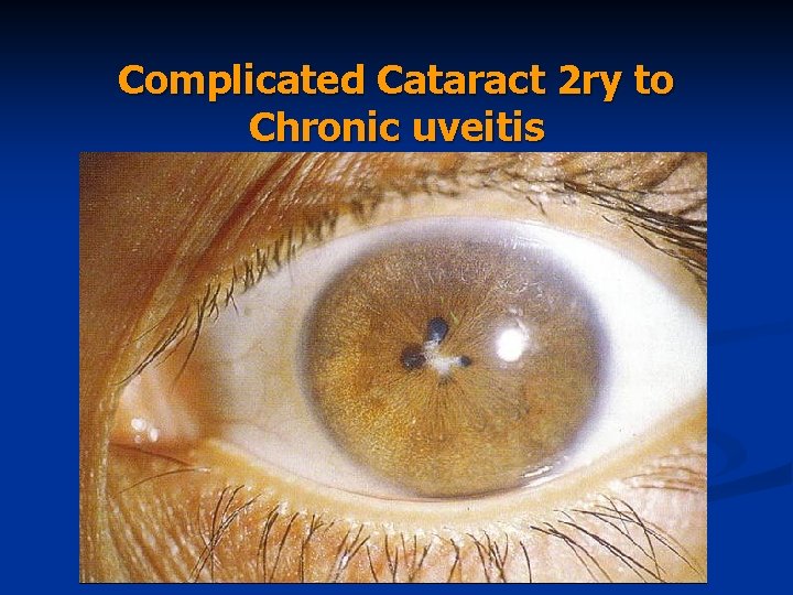 Complicated Cataract 2 ry to Chronic uveitis 