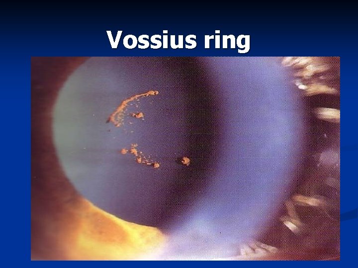 Vossius ring 