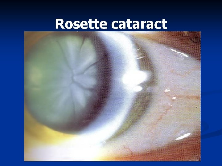 Rosette cataract 