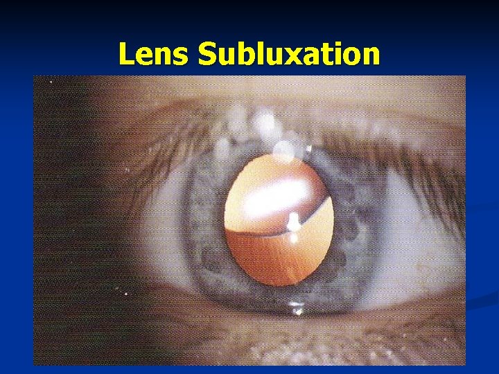 Lens Subluxation 